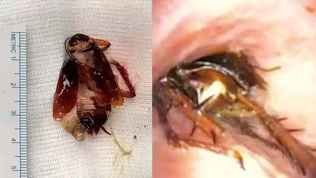 Cockroach Removed from a Lung